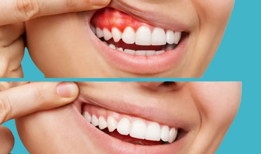 Diş Eti Tedavileri (Periodontoloji)