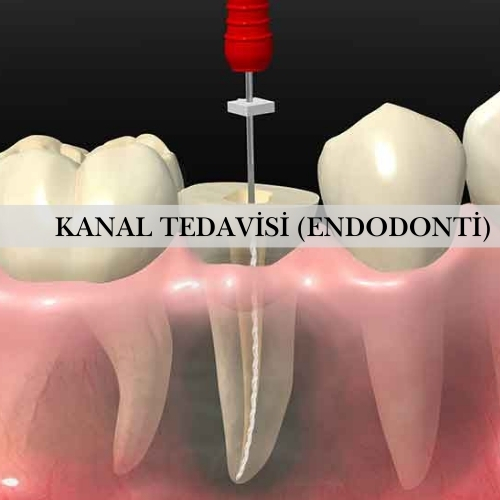 Kanal Tedavisi (Endodonti) - Pendik Diş Kliniği