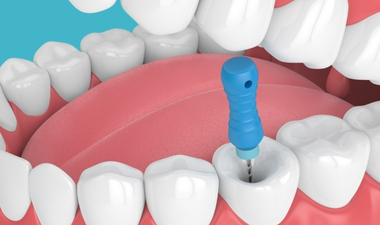 Kanal Tedavisi (Endodonti)