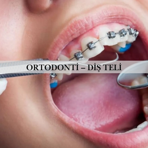 Ortodonti – Diş Teli - Pendik Diş Kliniği