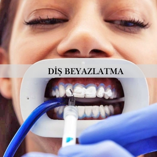 Diş Beyazlatma - Pendik Diş Kliniği