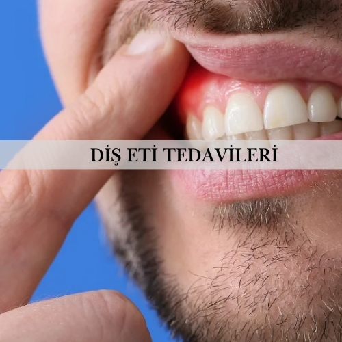 Diş Eti Tedavileri (Periodontoloji) - Pendik Diş Kliniği