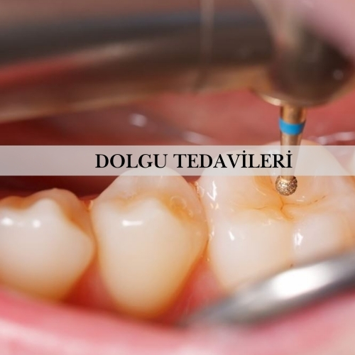 Dolgu Tedavileri - Pendik Diş Kliniği