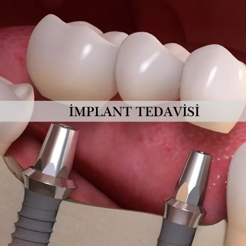 İmplant Tedavisi - Pendik Diş Kliniği